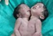 कोल्हुई में दुर्लभ चिकित्सकीय चमत्कार, पेट से जुड़ी जुड़वा बच्चियों का जन्म